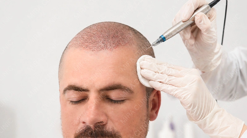 FUE for Large-Scale Coverage